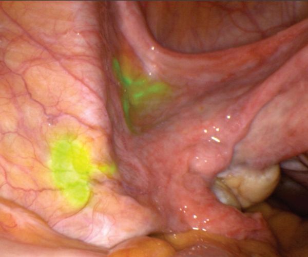 Nová diagnostická metóda na gynekologickom oddelení v Leviciach znižuje riziko komplikácií pri liečbe karcinómu maternice Nová diagnostická metóda na gynekologickom oddelení v Leviciach znižuje riziko komplikácií pri liečbe karcinómu maternice