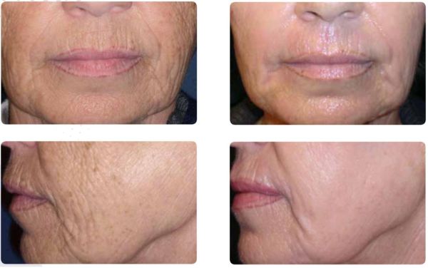 Levická nemocnica rozširuje služby o modernú laserovú dermatochirurgickú liečbu